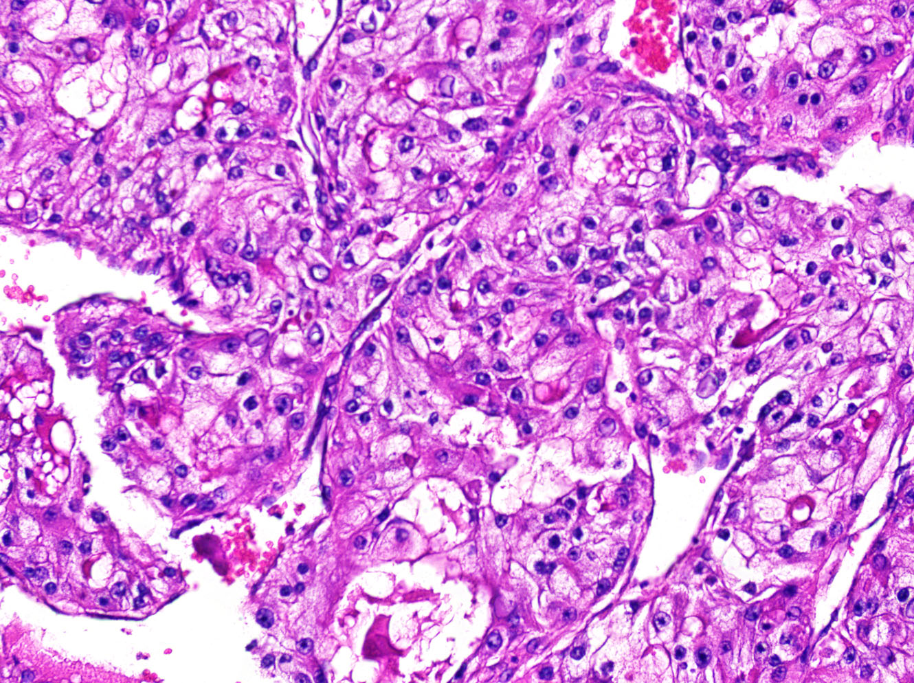 Kidney Cancer Samples Lab Ally