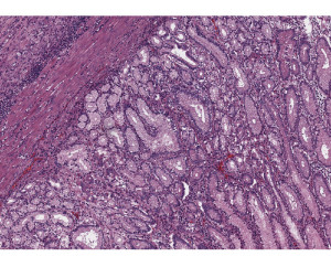 Sample from an esopho-gastrectomy, of mucinous adenocarcinoma, gastroesophageal junction.