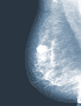 mammogram for breast cancer