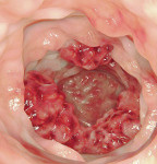 Cancer of the colon.