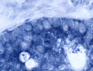 Colon cancer specimen, photographed at 40X. This sample is positive for miR-21 (indicated in blue).