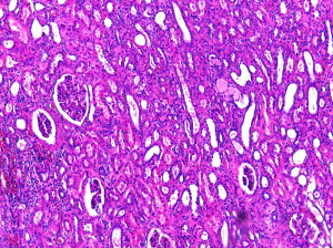 kidney cancer sample