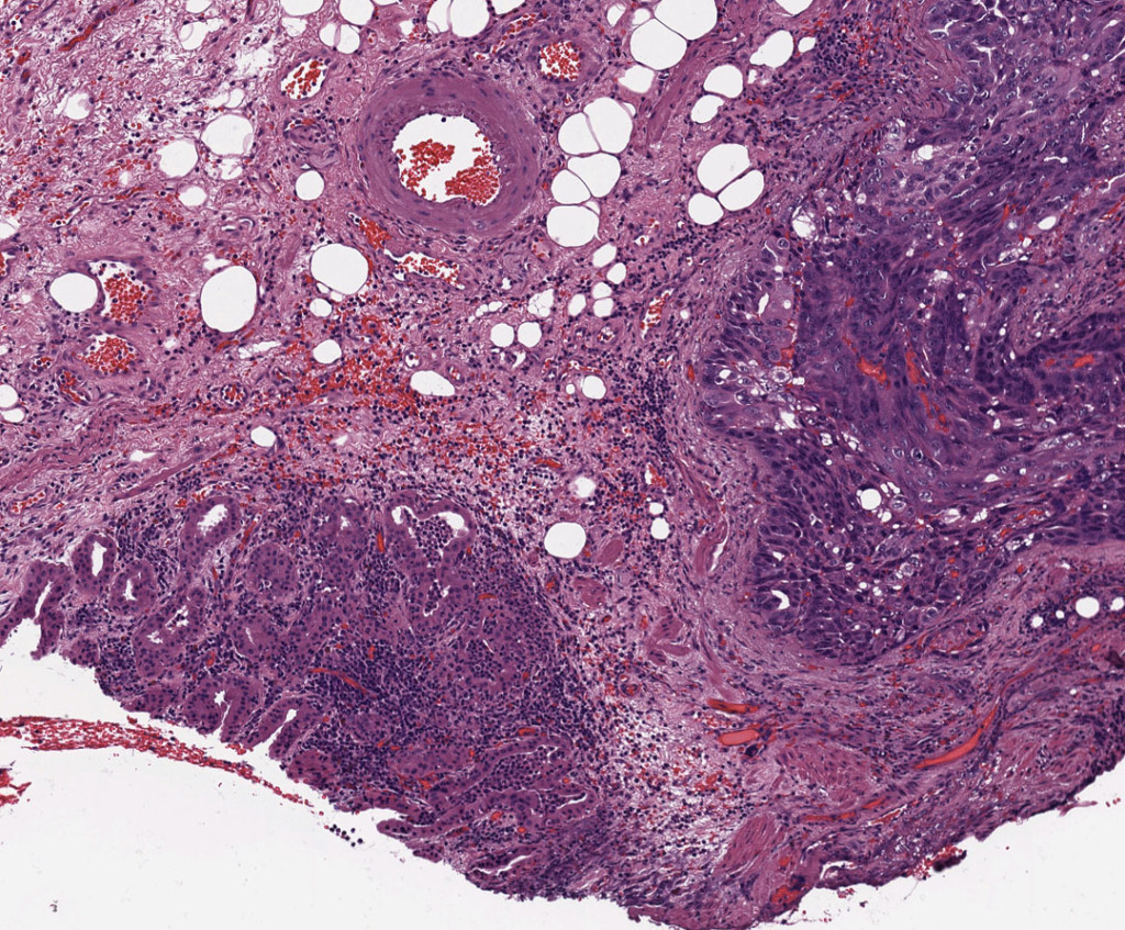 Gastric Cancer 3A LabAlly