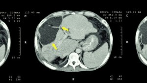 CT scan of upper abdomen, showing abnormal mass at the liver.